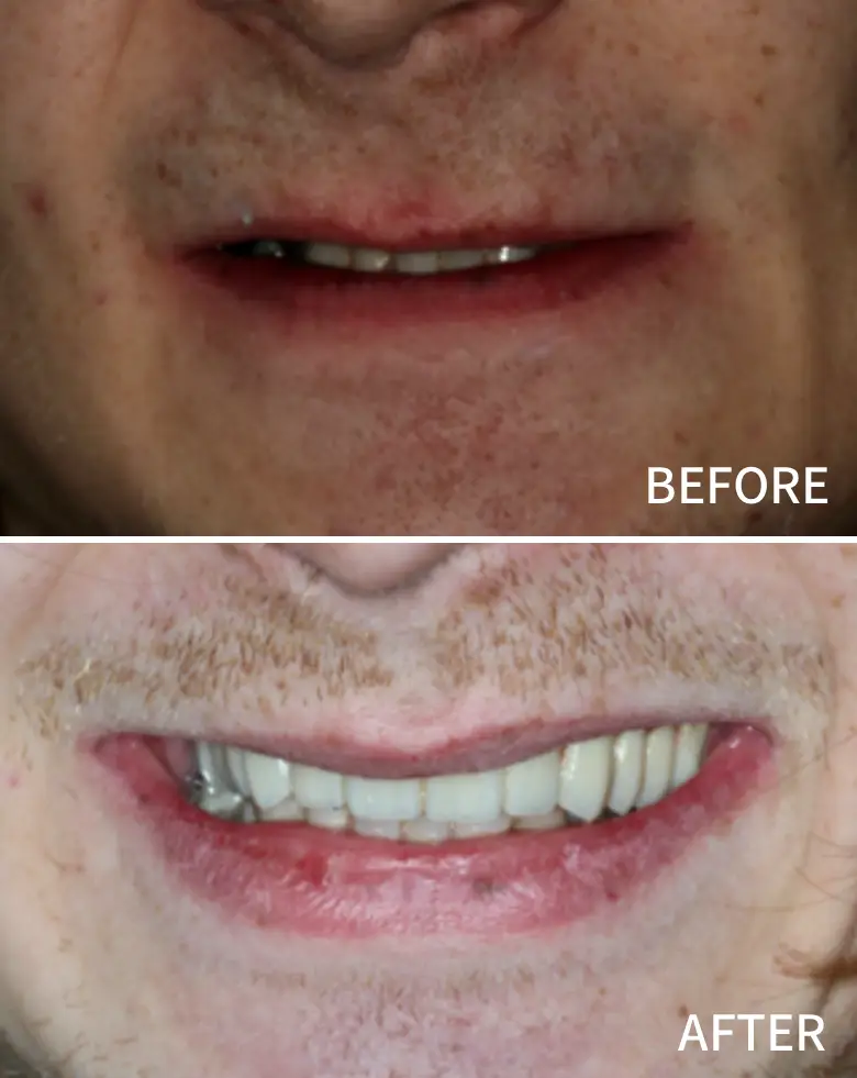 Before-and-after image showcasing full mouth rehabilitation, highlighting improvements in smile aesthetics, tooth alignment, and restoration of anterior teeth.