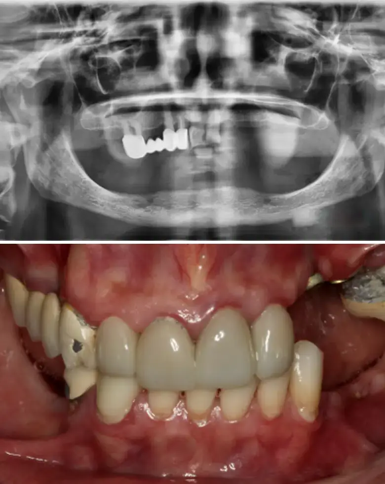 X-ray and clinical image showing full mouth rehabilitation, highlighting anterior tooth loss, multiple failing restorations, and improved dental aesthetics.
