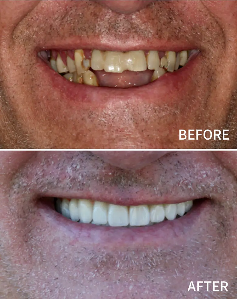 Before-and-after image of a male patient showcasing full mouth rehabilitation, highlighting significant improvements in tooth alignment, color, and overall smile aesthetics, addressing issues like anterior tooth loss and malocclusion.