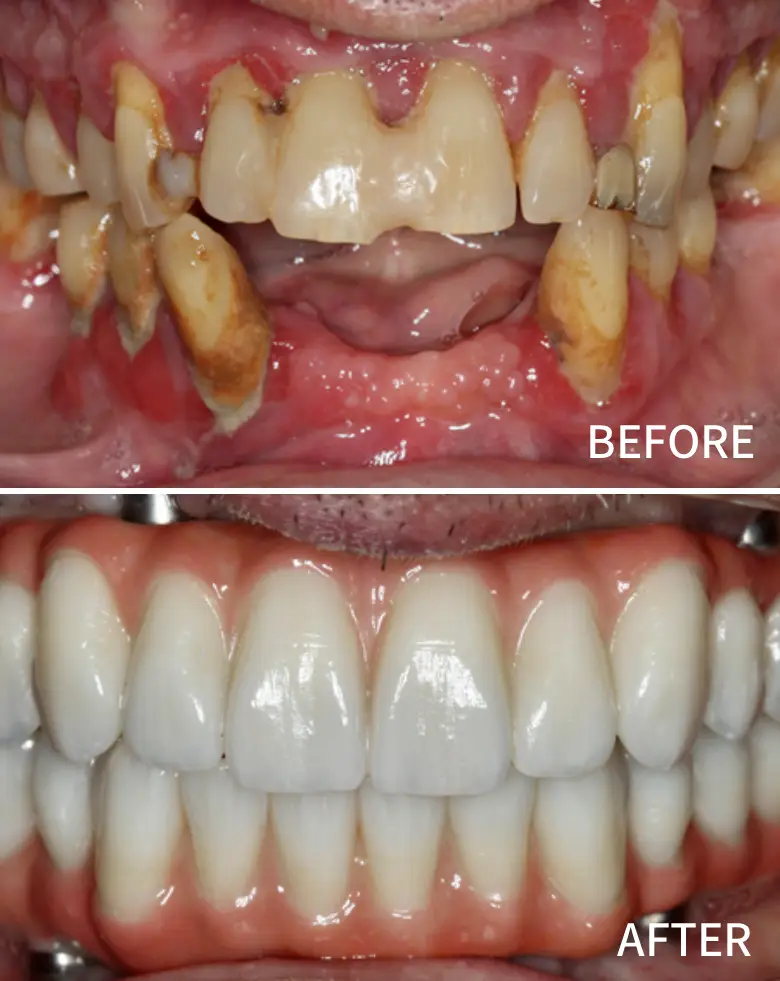 Before-and-after image of full mouth rehabilitation, showcasing significant dental transformation from multiple failing restorations and tooth wear to a restored, healthy smile with aligned teeth.