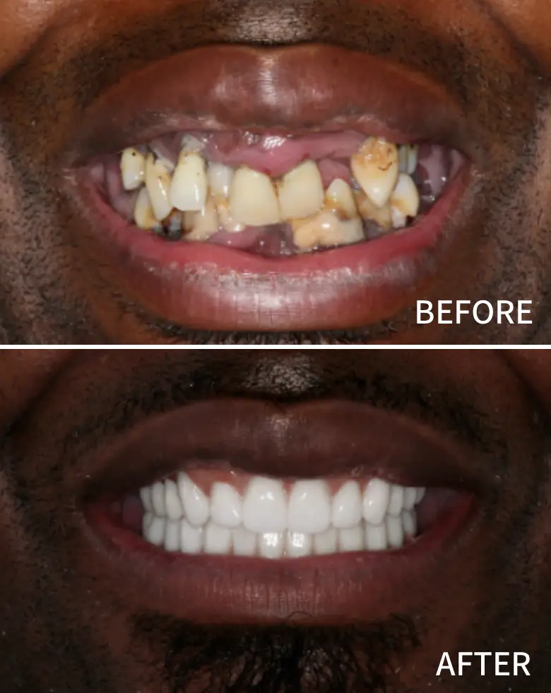 Before-and-after image of a full mouth rehabilitation, showcasing significant dental transformation, including correction of diastema, anterior tooth loss, and restoration of smile aesthetics.