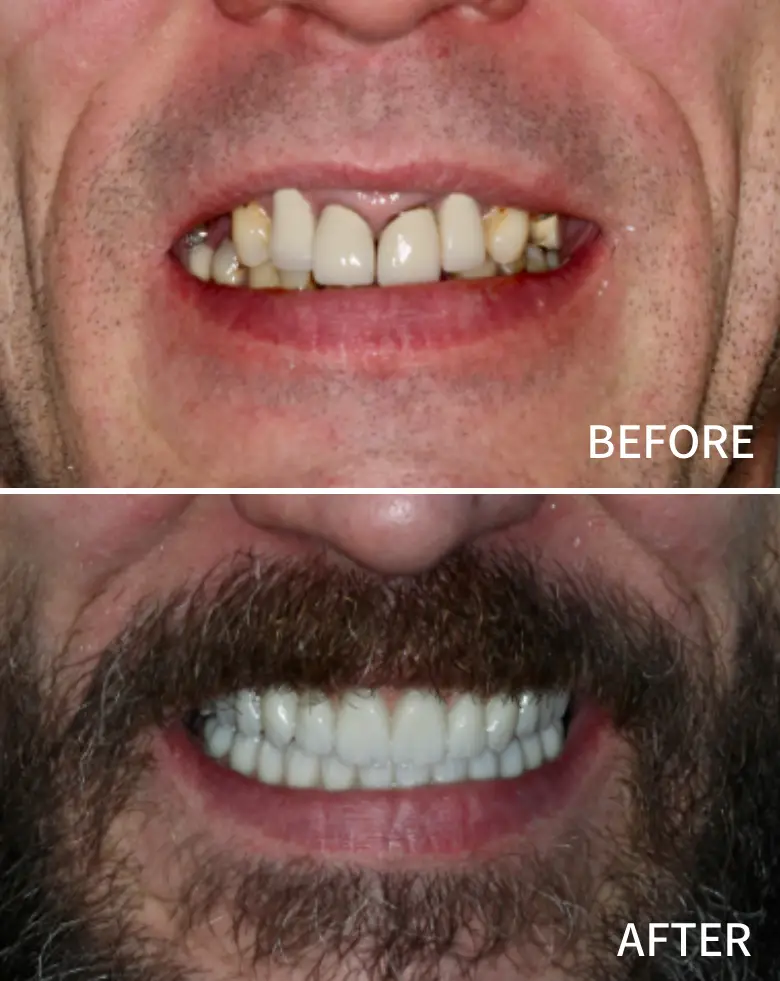 Before-and-after image of a man's smile transformation, showcasing dental restoration results, improved tooth alignment, and enhanced aesthetics, relevant to full mouth rehabilitation and smile makeover services at NuSmile Implant Studio.