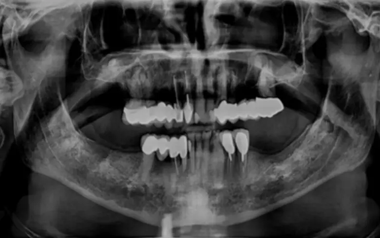 X-ray image showing full mouth dental structure with multiple implants, indicating cases of anterior tooth loss and potential rehabilitation.