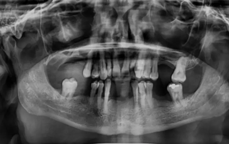 Full mouth X-ray showing multiple failing restorations, anterior tooth loss, and generalized tooth wear, relevant to full mouth rehabilitation and cosmetic dentistry.