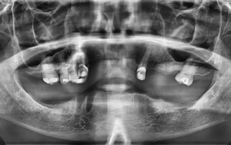 X-ray image showing multiple failing restorations, anterior tooth loss, and generalized tooth wear, relevant to full mouth rehabilitation.