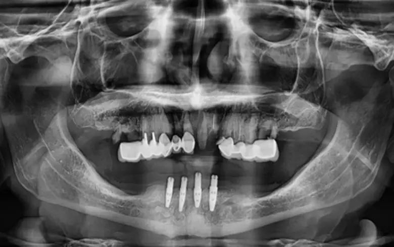 X-ray image showing full mouth rehabilitation with dental implants, highlighting anterior tooth loss and multiple failing restorations.
