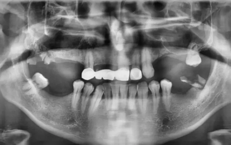 X-ray image showing full mouth dental condition, highlighting diastema, anterior tooth loss, and multiple failing restorations, relevant to full mouth rehabilitation.