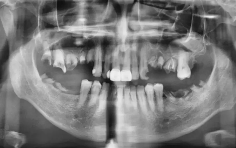 X-ray image of a dental full mouth rehabilitation case showing multiple failing restorations, anterior tooth loss, and generalized tooth wear.