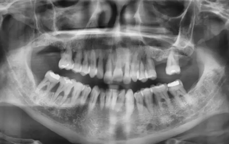 X-ray image of a full mouth showing dental structures, highlighting issues like diastema, anterior tooth loss, and generalized tooth wear relevant to full mouth rehabilitation.