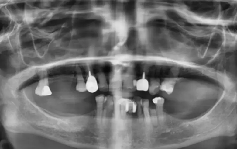 X-ray image of full mouth showing multiple failing restorations, anterior tooth loss, and areas of generalized tooth wear, relevant to full mouth rehabilitation at NuSmile Implant Studio.