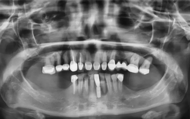 Full mouth X-ray showing multiple dental issues including diastema, anterior tooth loss, and failing restorations, relevant to full mouth rehabilitation at NuSmile Implant Studio.