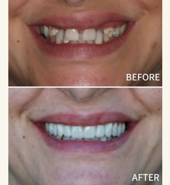 Before and after images of a full mouth reconstruction showcasing significant improvement in dental aesthetics and function, highlighting restored teeth alignment and a balanced smile.