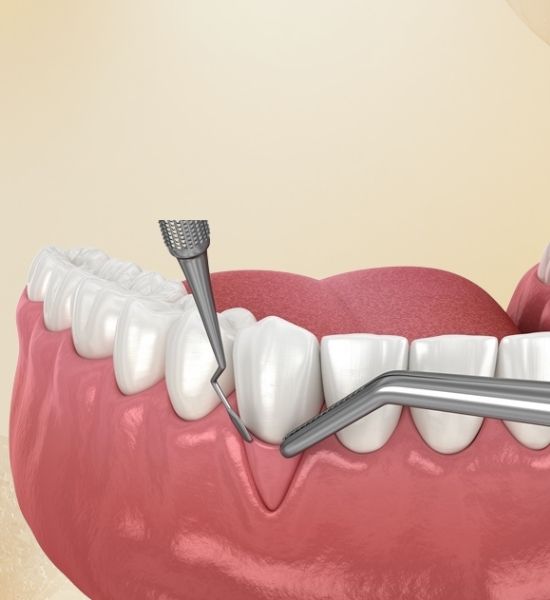 Gum surgery tools applied to healthy gum tissue, illustrating the procedure for treating advanced gum disease at NuSmile Implant Studio.
