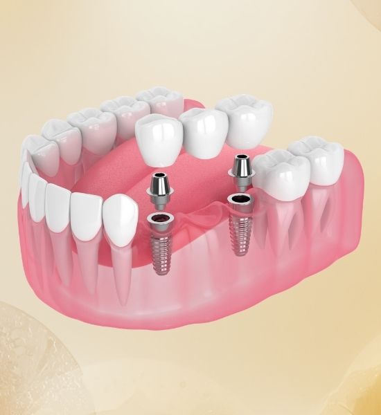 Implant-supported dental bridge model showcasing dental implants and artificial teeth, illustrating the method of replacing multiple missing teeth for enhanced stability and aesthetics.