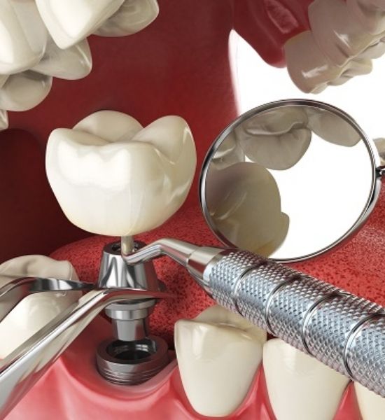 Implant Procedure Image | Dental Implant Beverly Chicago, IL | NuSmile Implant Studio