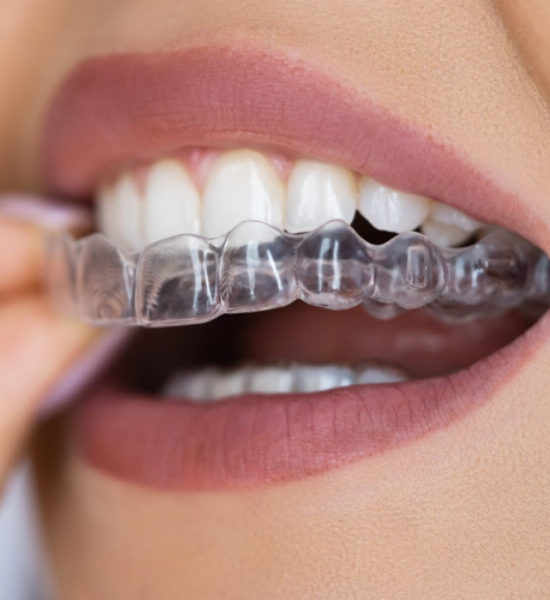 Person inserting clear Invisalign aligner, showcasing teeth alignment and orthodontic treatment benefits.