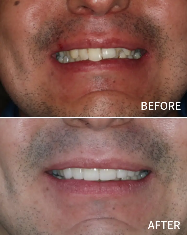 Before-and-after images of a dental transformation showcasing improved smile aesthetics, addressing malocclusion, anterior tooth loss, and overall smile rehabilitation.