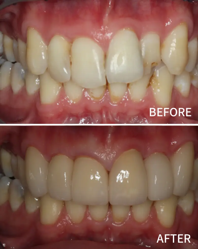 Before-and-after images of dental rehabilitation showcasing improved alignment, enhanced aesthetics, and restoration of anterior teeth following treatment for malocclusion and generalized tooth wear.