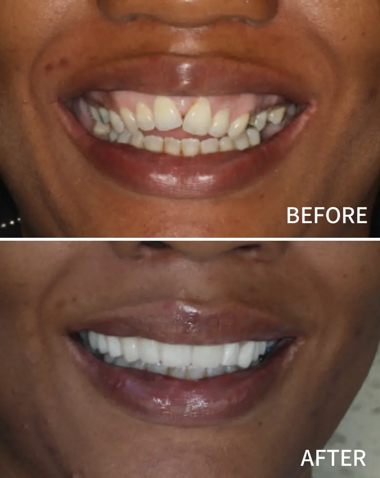 Before-and-after image showcasing a smile transformation, highlighting malocclusion correction, improved tooth alignment, and enhanced aesthetics of the teeth.