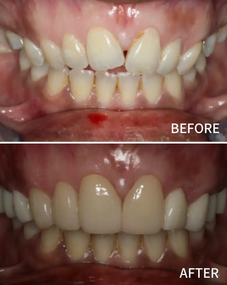 Before-and-after image of a dental transformation showcasing improved alignment and aesthetics of anterior teeth, addressing malocclusion and tooth wear.