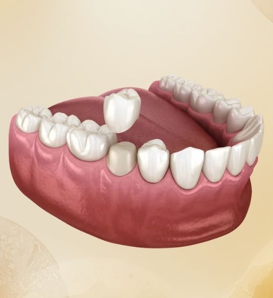 3D rendering of a dental arch featuring porcelain crowns on upper and lower teeth, illustrating custom dental restorations for enhanced aesthetics and tooth strength at NuSmile Implant Studio.