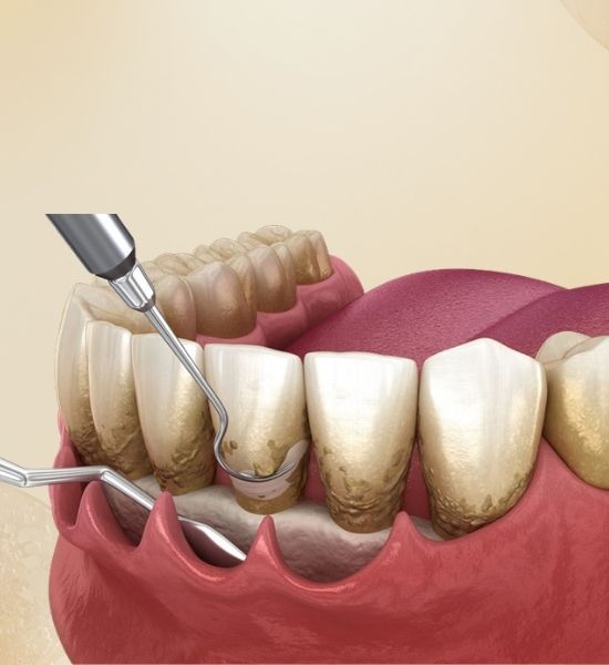 Illustration of dental instruments performing osseous surgery on teeth to treat advanced periodontal disease, focusing on reshaping the underlying bone structure for improved oral health.