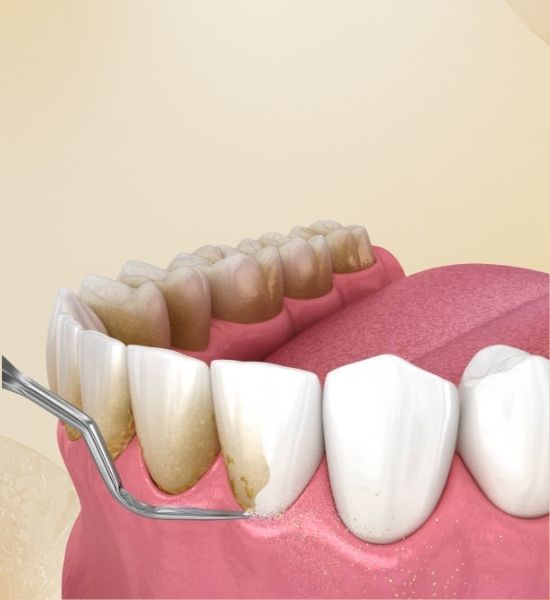 Illustration of teeth showing plaque buildup on gums, highlighting the importance of periodontal treatment for maintaining gum health and supporting structures of teeth.