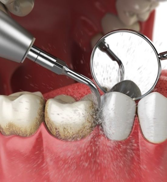 Dental cleaning tools in action, removing plaque and tartar from teeth, emphasizing oral health and routine maintenance.