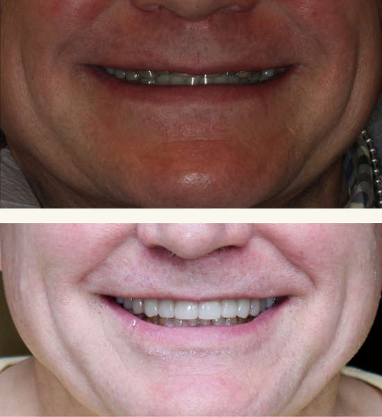 Before and after images showcasing a dental restoration transformation, highlighting improved smile aesthetics and functionality through advanced restorative dentistry.