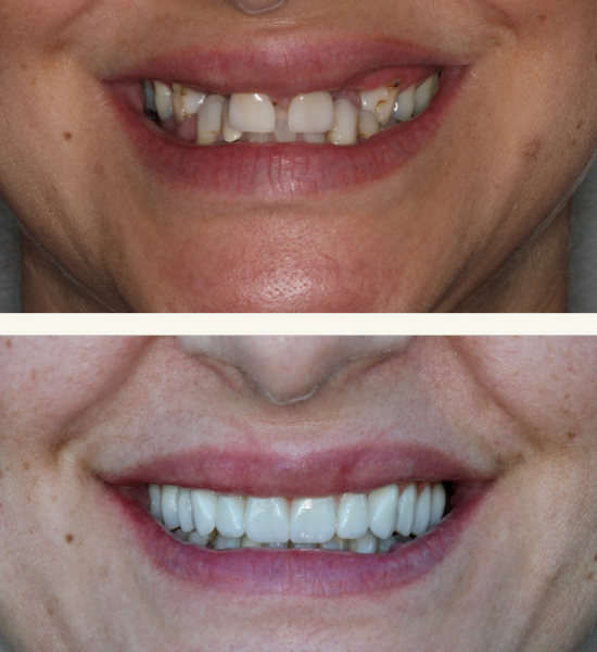 Before and after images of a smile makeover showing significant improvement in tooth color, alignment, and overall appearance, highlighting the transformative results of cosmetic dental procedures at NuSmile Implant Studio.
