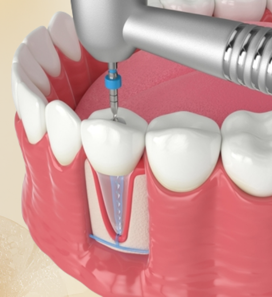 Dental surgical tool preparing for root canal treatment on a tooth model, illustrating restorative dentistry techniques.