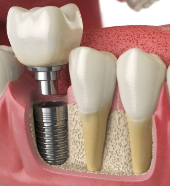 Dental surgical implant model showing implant post, abutment, and crown, illustrating complex dental restoration process for patients with significant tooth loss.