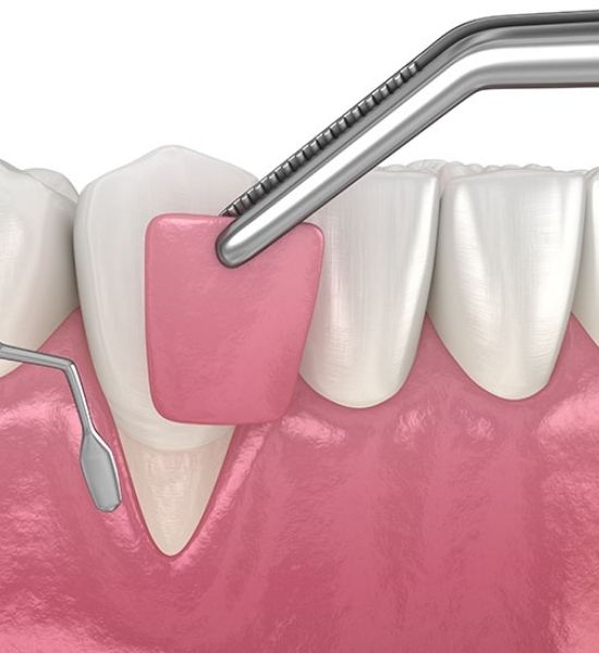 Illustration of tissue grafting procedure, showing a dental tool applying a graft to receded gum tissue near teeth, emphasizing gum restoration and aesthetic improvement.