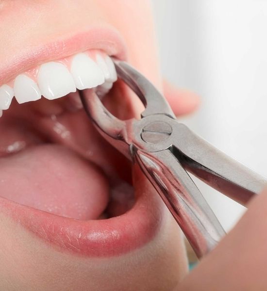 Dental extraction procedure with dental pliers grasping a tooth, emphasizing patient care and oral health at NuSmile Implant Studio.