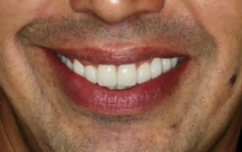 Close-up of a smiling man showcasing bright, white teeth, highlighting dental transformation results from NuSmile Implant Studio.