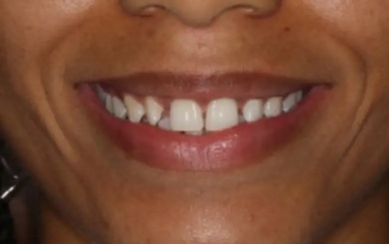 Close-up of a smiling individual showcasing a bright, healthy smile with well-aligned teeth, illustrating dental transformation results from NuSmile Implant Studio.