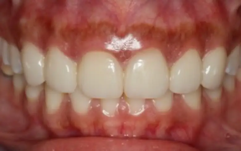 Close-up of a dental transformation showcasing a straight, white smile with healthy gums, highlighting the results of cosmetic dentistry at NuSmile Implant Studio.