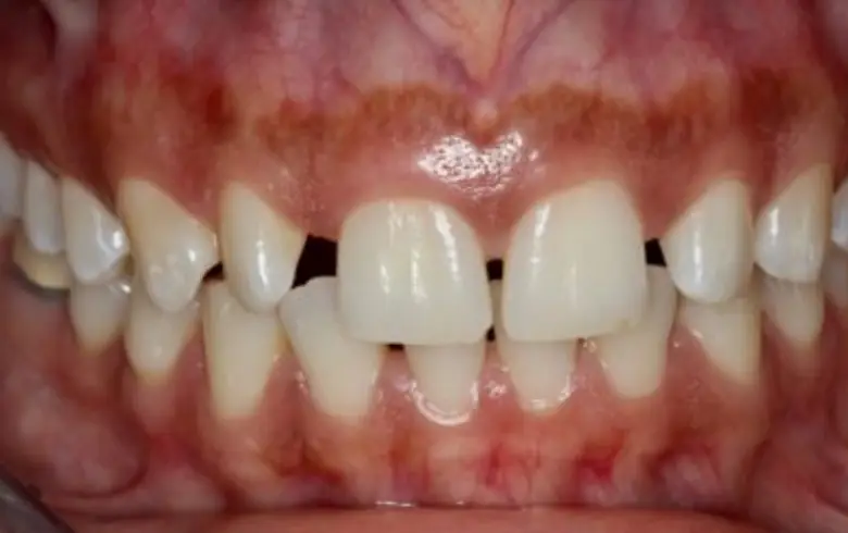 Close-up of a smile showcasing uneven teeth, highlighting dental transformation potential in cosmetic dentistry at NuSmile Implant Studio.