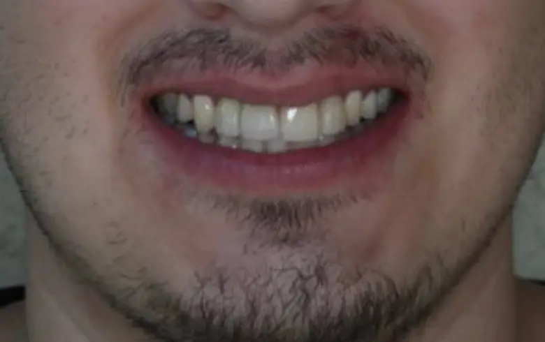 Close-up of a man's smile showcasing dental transformation with visible teeth and facial hair, highlighting the results of cosmetic dentistry at NuSmile Implant Studio.