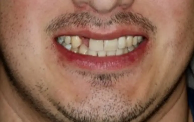 Man smiling with visible dental imperfections, showcasing before dental transformation at NuSmile Implant Studio.