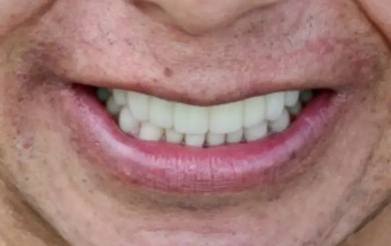 Close-up of a smiling mouth showcasing bright, straight teeth, highlighting dental transformation results from NuSmile Implant Studio.