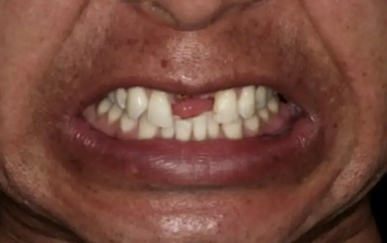 Close-up of a person's mouth showing dental issues, including missing teeth and uneven alignment, relevant to dental transformation services at NuSmile Implant Studio.
