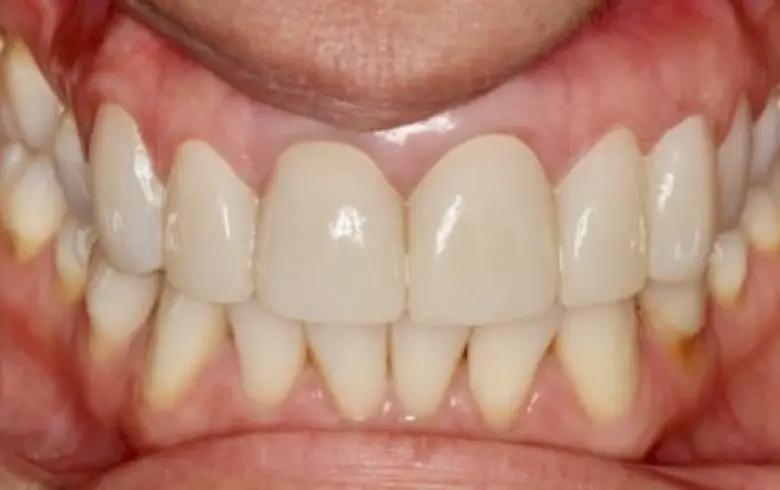Close-up of a well-aligned set of teeth showcasing a bright, white smile, highlighting dental transformation results from NuSmile Implant Studio's cosmetic dentistry services.