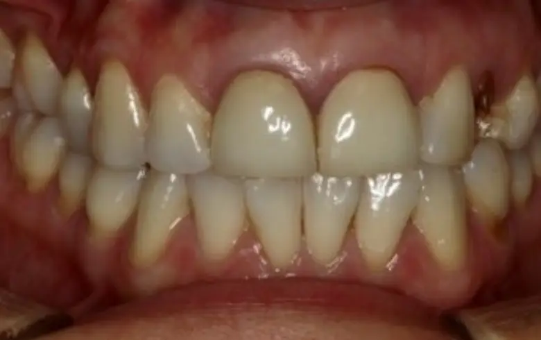Close-up of a smile showcasing dental transformation with aligned teeth and healthy gums, highlighting cosmetic dentistry results at NuSmile Implant Studio.