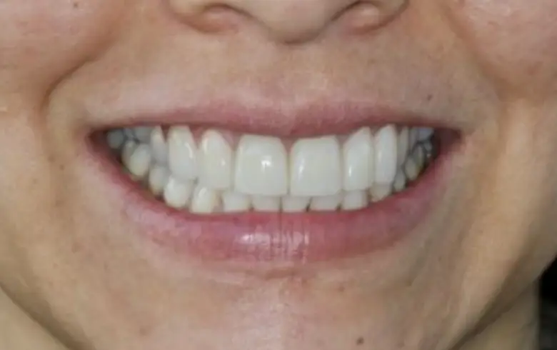 Close-up of a smiling person showcasing a bright, straight smile with white teeth, highlighting the dental transformation services at NuSmile Implant Studio.
