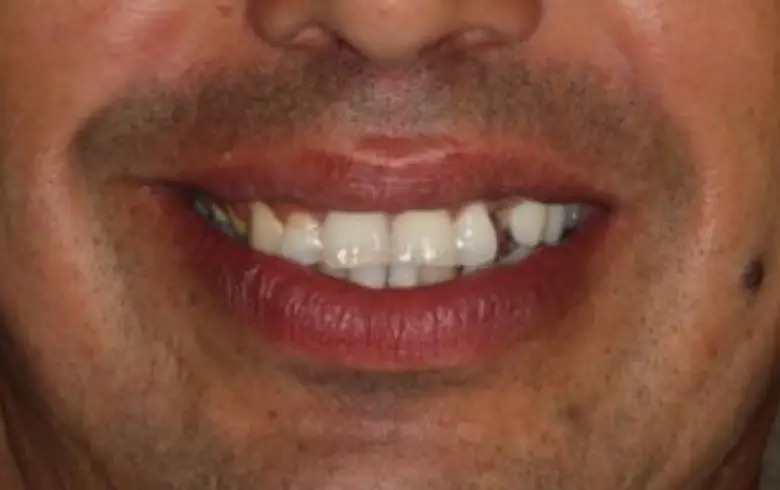 Close-up of a smiling person showcasing dental transformation with visible dental implants and cosmetic enhancements, highlighting results from NuSmile Implant Studio.