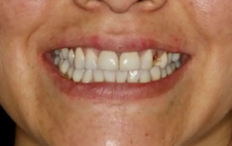 Before-and-after dental transformation showcasing a smile with noticeable tooth alignment and cosmetic improvement at NuSmile Implant Studio.