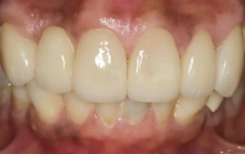 Close-up of a smile showcasing well-aligned, polished teeth, highlighting cosmetic dental results from NuSmile Implant Studio.