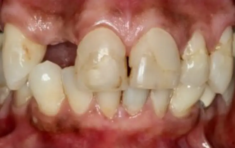 Before-and-after dental transformation showcasing teeth with discoloration and wear, highlighting the need for cosmetic dentistry services at NuSmile Implant Studio.