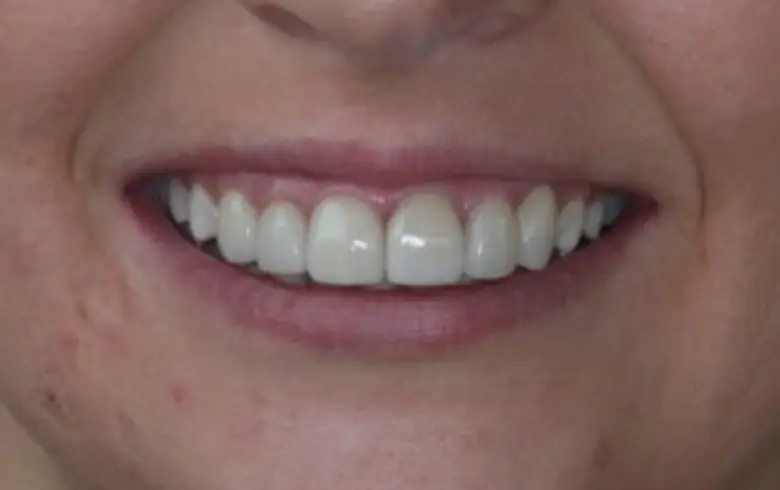 Close-up of a smiling person showcasing bright, straight teeth, highlighting dental transformation results from NuSmile Implant Studio.